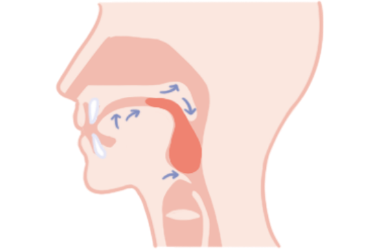 5期モデルの4、咽頭期。食塊を咽頭から食道入口部へ送り込む。