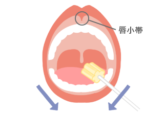 スポンジブラシを使った口腔ケア。